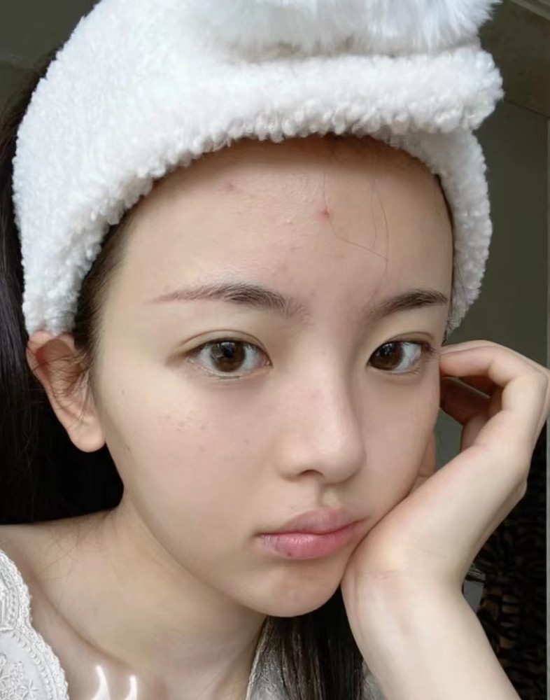 杨超越晒素颜照脸上痘痘脂肪粒明显配文我就当是一种风格了