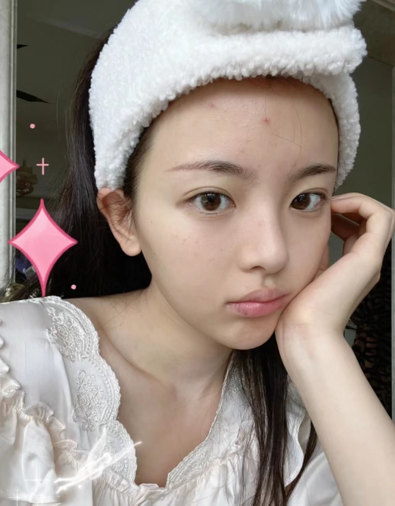 杨超越晒素颜照脸上痘痘脂肪粒明显配文我就当是一种风格了