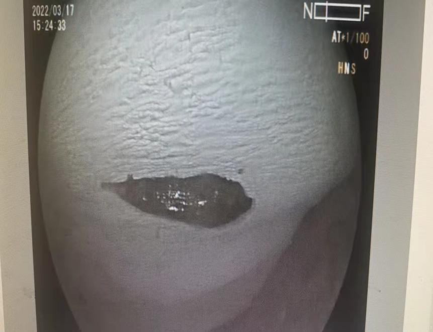 七旬老人误吞枣核一个月差点肠穿肚烂哈医大一院群力院区马志斌教授小