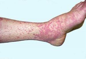 过敏性紫癜是病患全身不只是皮肤疾病