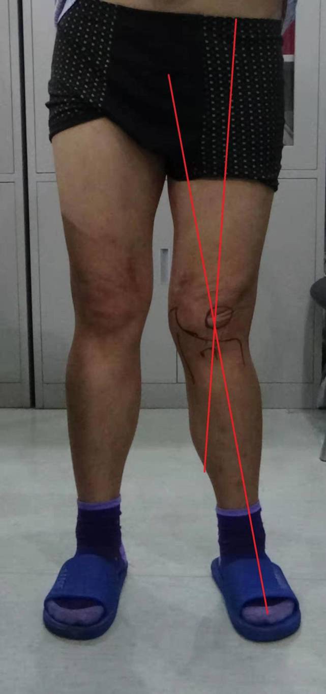 o型腿和x型腿需要矫正医生这是膝关节畸形影响美观和健康