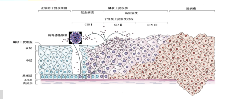 每週一課第11期精彩分享|王華麗教授:hpv感染與宮頸癌疫苗_騰訊新聞