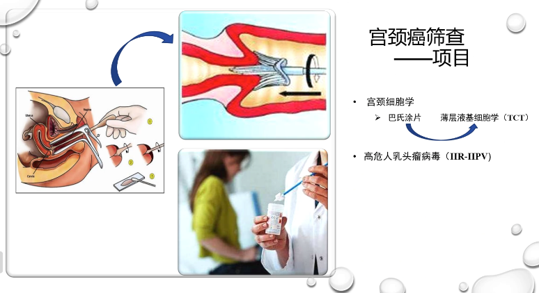 王教授在此提出,取材时要尽量使小毛刷的刷头伸入宫颈管内,旋转10周