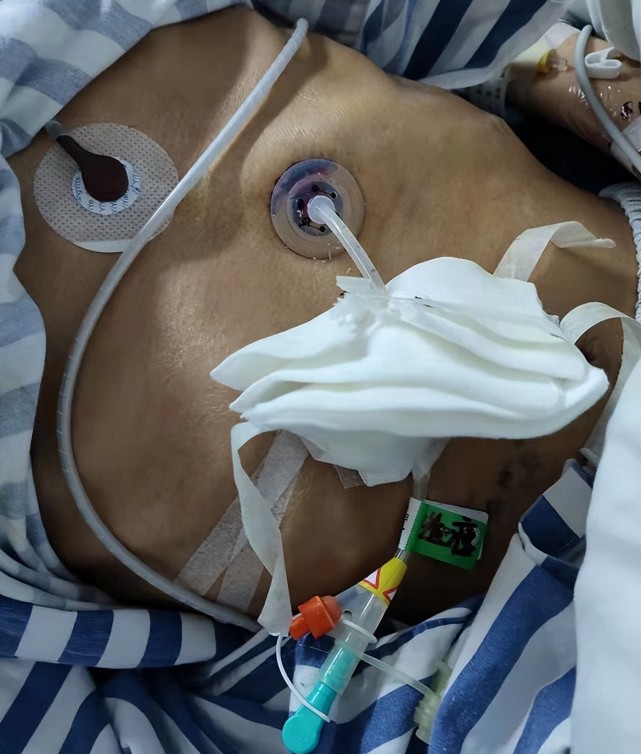 微创造瘘术为无法进食罕见病患者开辟生命通道