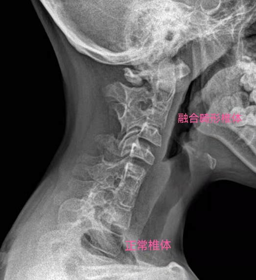 先天性颈椎融合畸形图图片