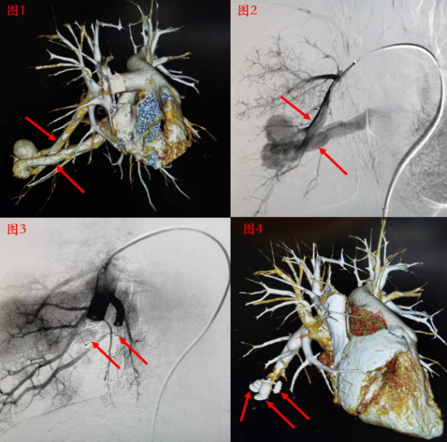 容易被误诊的肺血管畸形齐鲁医院首次微创治疗肺动静脉瘘