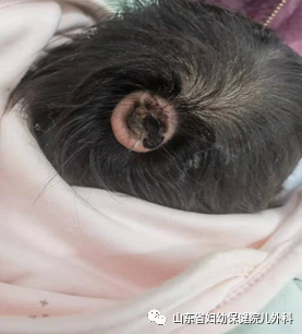 婴儿头颅变形原是脑膜膨出山东省妇幼这个异常要警惕