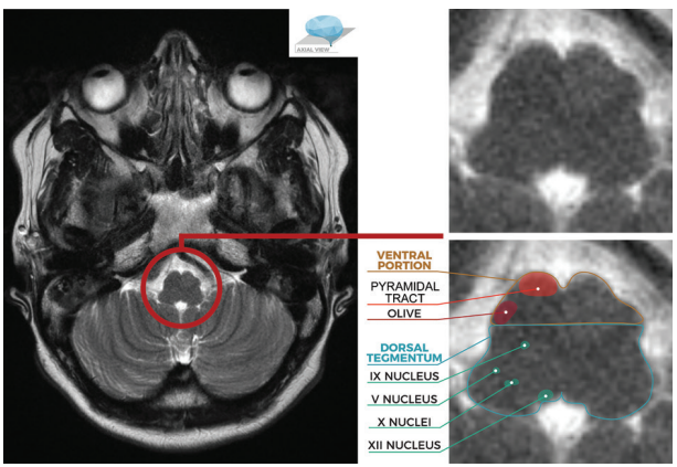 图文并茂一文掌握延髓解剖结构及常见综合征