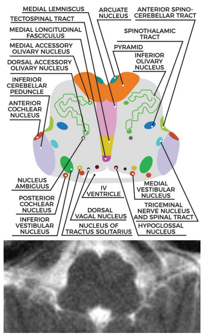 图文并茂一文掌握延髓解剖结构及常见综合征