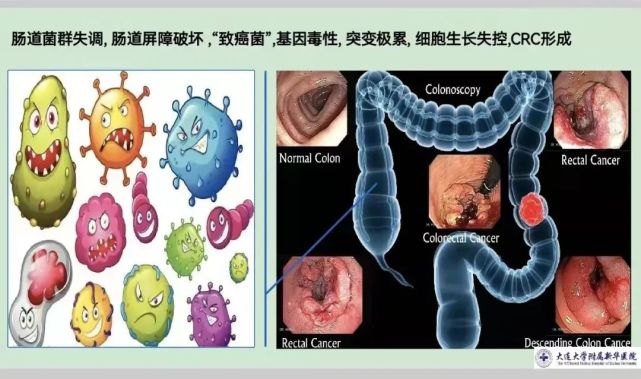 趙長林教授:生物鐘紊亂,腸道菌群失調會增加結直腸癌發生風險嗎?