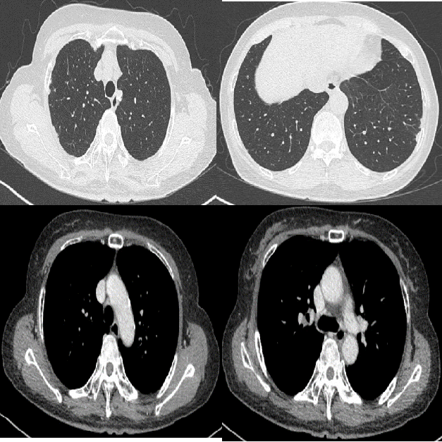胸膜下反复变化的多发结节,这个患者究竟是什么病?