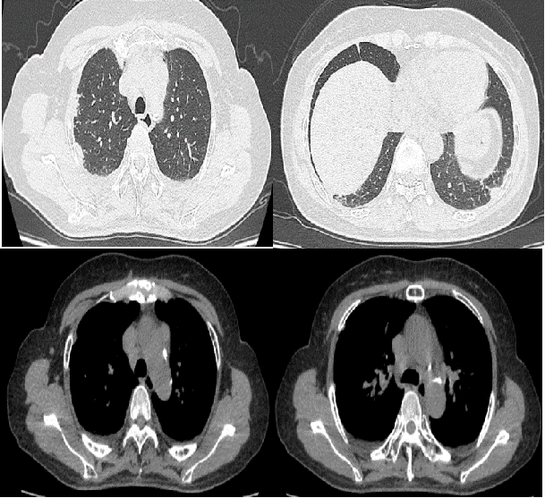 胸膜下反复变化的多发结节,这个患者究竟是什么病?