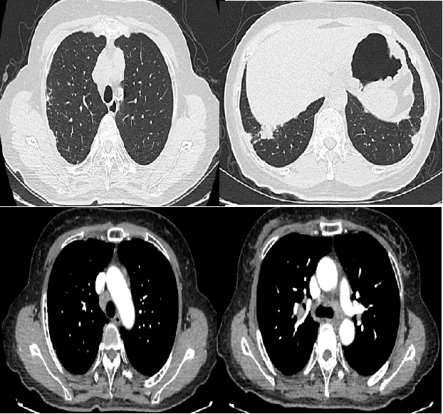 2021 年 7 月查胸部 ct 提示:双肺多发实性结节,双侧胸膜结节样增厚.