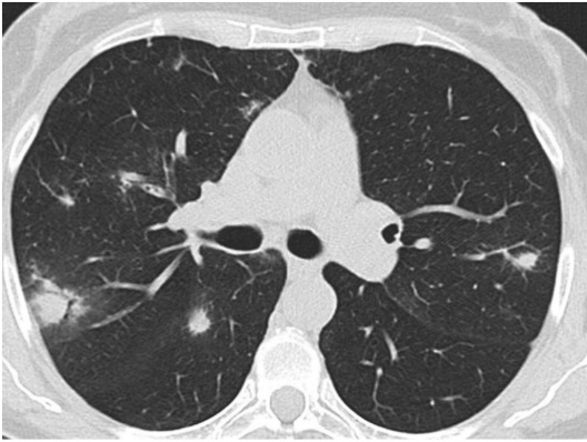 胸膜下反复变化的多发结节,这个患者究竟是什么病?
