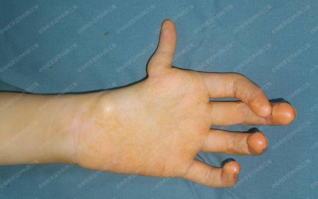 如果拇指功能丧失,我们的生活会出现哪些变化?
