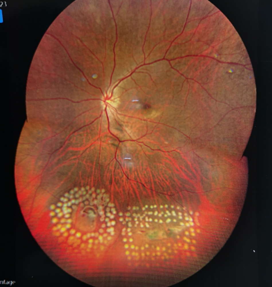 激光治疗后的眼底照相图片裂孔出现后有什么感觉?