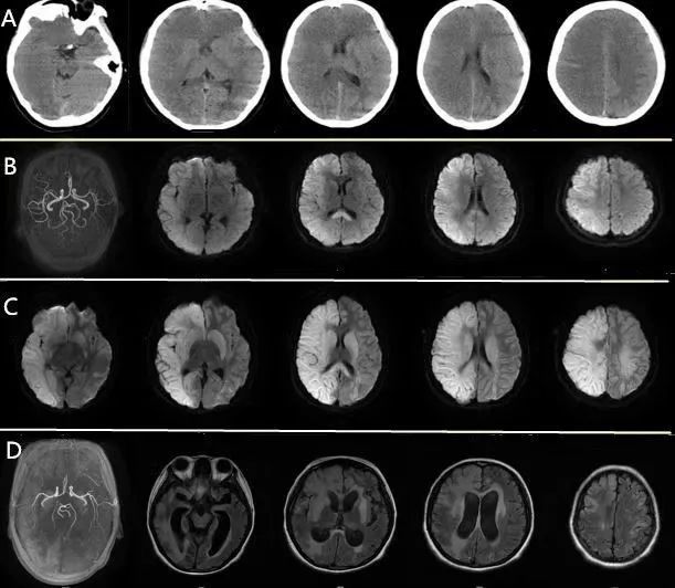 頭顱mri mra dwi swi:右側額顳頂枕葉及胼胝體壓部急性腦梗死可能性大