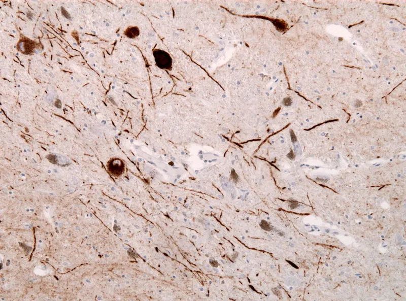 发现者德裔美国神经科学家弗德里克·路易(frederic lewy)在研究