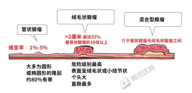 肠子里发现这种肉警惕会癌变越早切掉越好