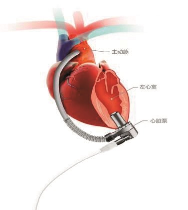 华南首例54岁女士植入全球最小最轻人工心脏两月