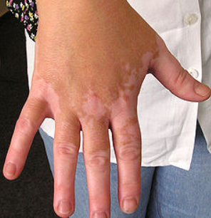 得了白癜风的人能不能吃维生素c:一,对于白癜风患者,平时生活中是一定