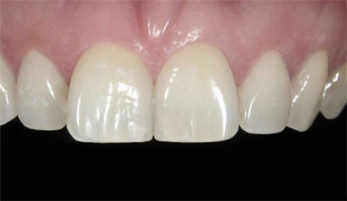 牙齿贴面做了后悔死了,真不知这树脂牙贴面害了多少人