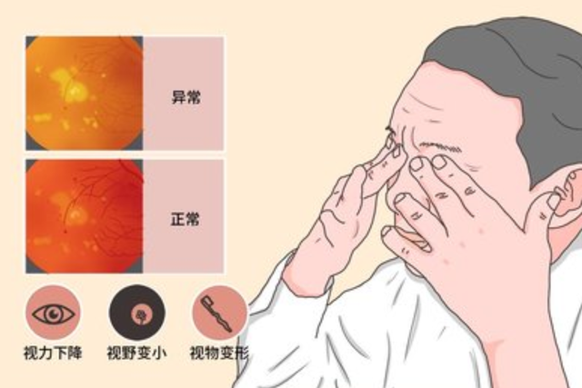 中老年人看东西色彩变暗扭曲变形很有可能是患上了这种眼病