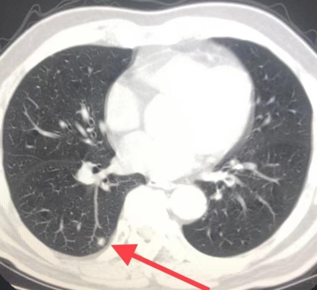 發現肺結節,應當帶上詳細的影像資料dr,ct片去肺結節門診或者呼吸內科