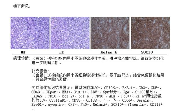 细胞弥漫性生长,基于 he 形态,结合免疫组化结果,符合恶性黑色素瘤