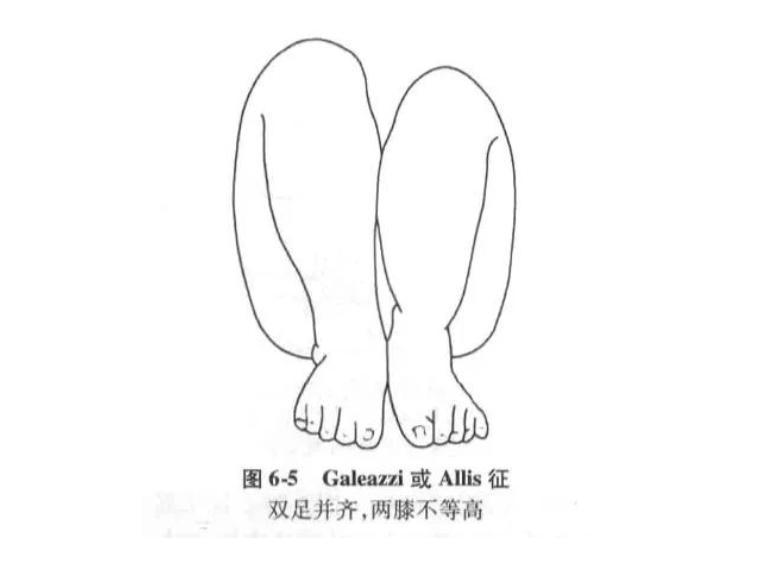 宝宝长短腿家长警惕这个病