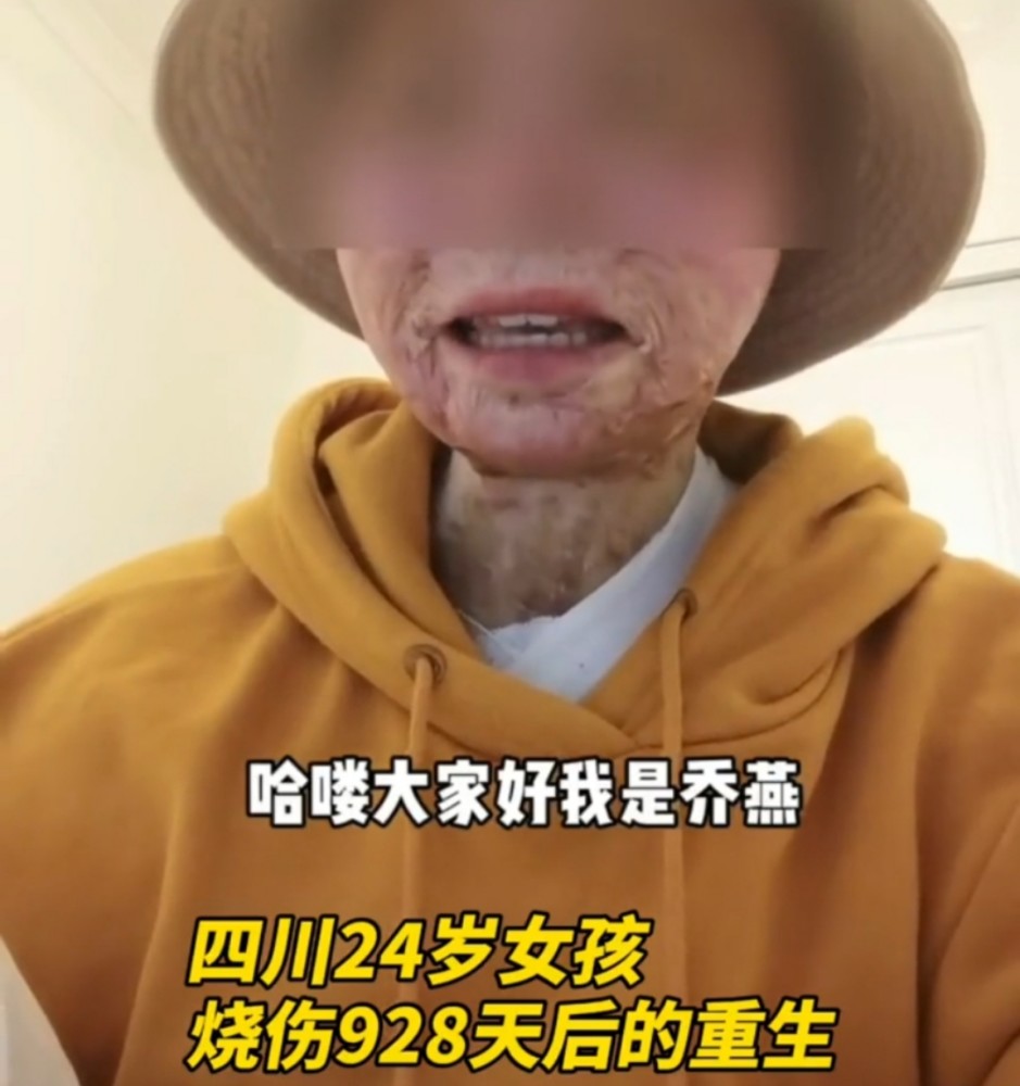 美女被燒傷退928天后的重生