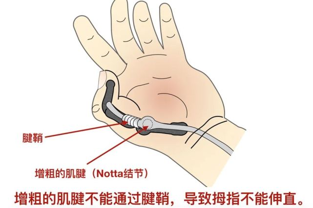 都是勤勞惹的禍手腕疼小心得了腱鞘炎