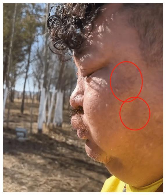 由于过度肥胖,恩克平时连出门都费劲,走两步就会气喘吁吁,坐车还怕