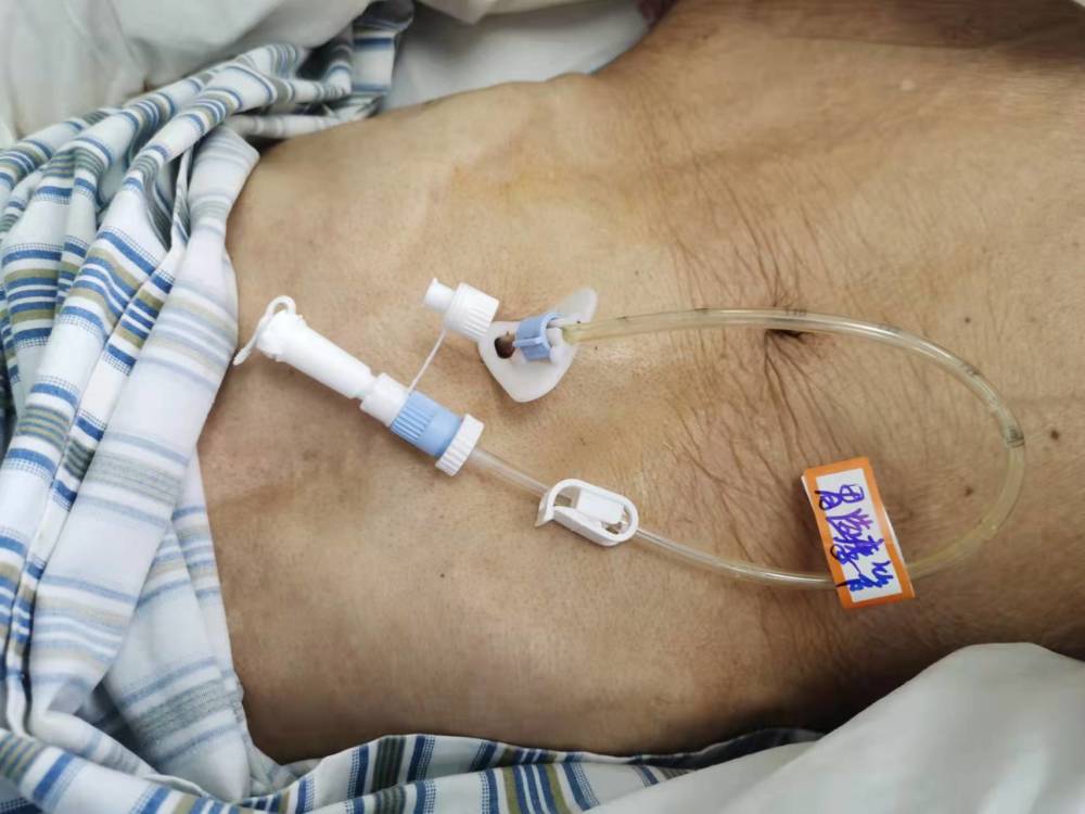 昆明市延安医院呈贡医院完成首例经皮内镜下胃造瘘术