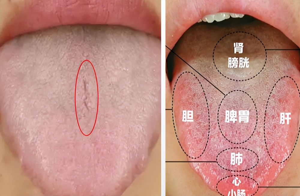 舌头有裂纹究竟是身体出现了什么问题今天沈医生一次给你讲明白