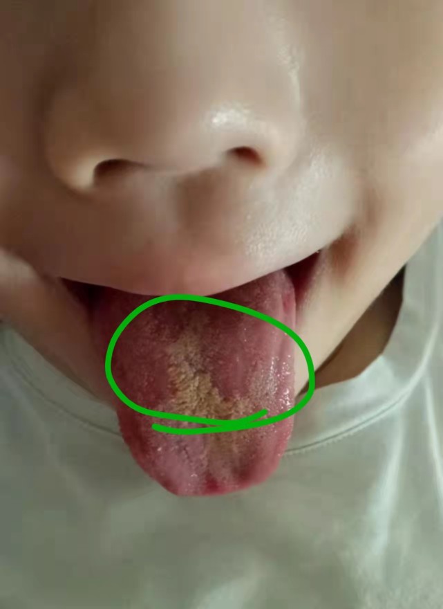 地图舌(舌苔不规则地剥脱(掉苔),形成像地图一样,简称它地图舌),具体