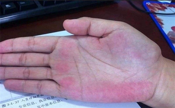 体内有疾 手指先知 手上出现这5种现象 警惕身体亮红灯 腾讯新闻