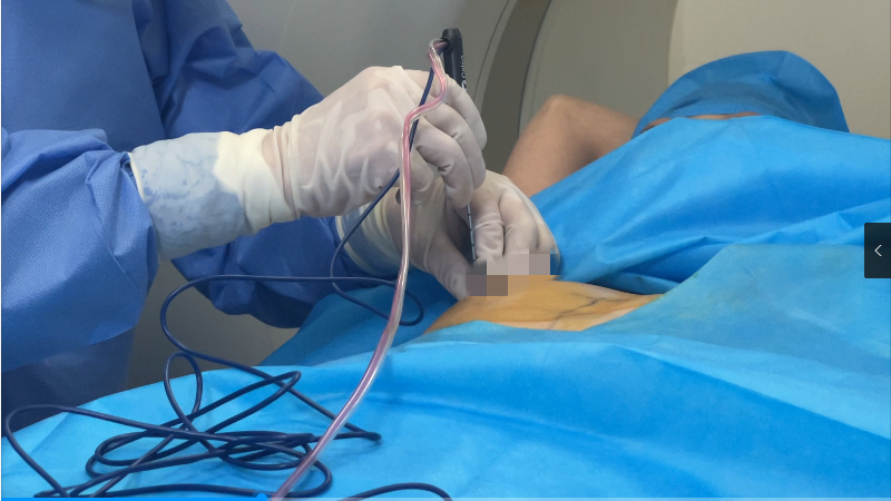 西安市红会医院完成陕西首例ct引导下3d打印模板定位肺结节射频消融及