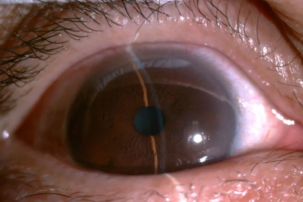 反应,且双眼眼压高伴有炎症,诊断为"双眼急性闭角型青光眼(右眼慢性期