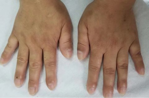 肿瘤专家手指出现这个变化千万要小心这可能是肺癌的前期信号