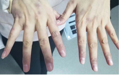 肿瘤专家手指出现这个变化千万要小心这可能是肺癌的前期信号