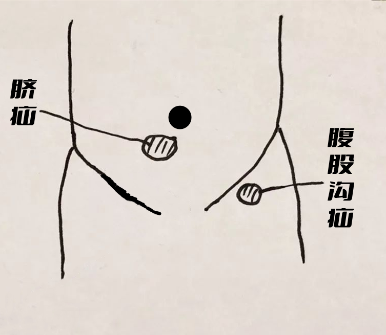 寶爸寶媽注意了寶寶這些症狀可能是疝氣