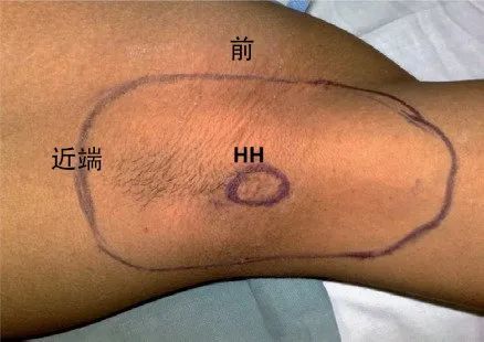 引起女性腋窩疼痛的神經分析