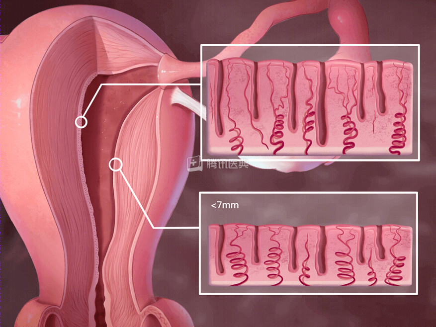 Thin endometrial lining, will it affect pregnancy? Healthy Lifestyle
