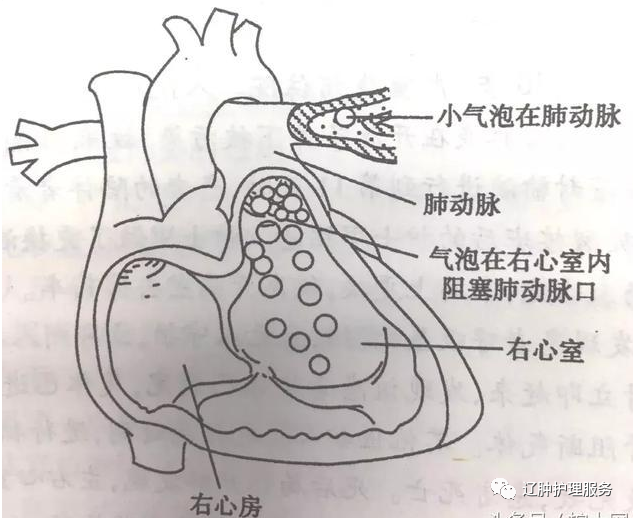 空气栓塞心脏图片图片