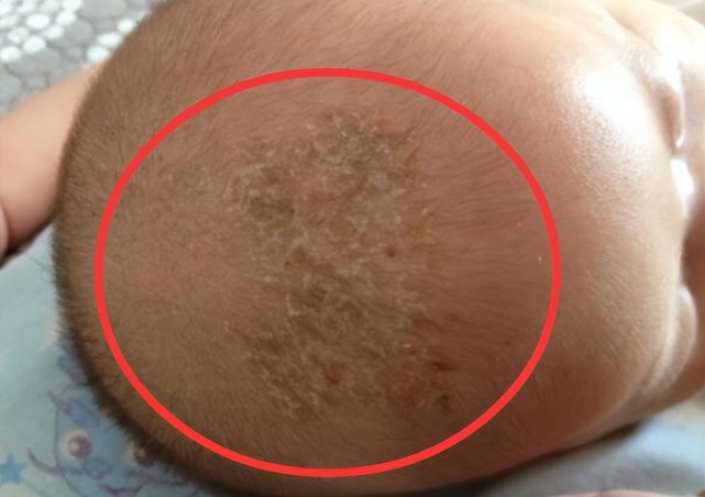 家长总是给宝宝抠乳痂看上去是爱干净其实有些坑娃