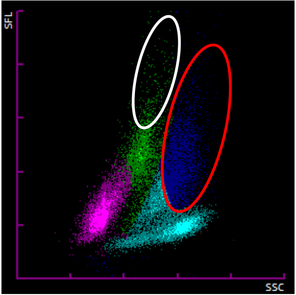 血常规异常白细胞散点图案例汇总