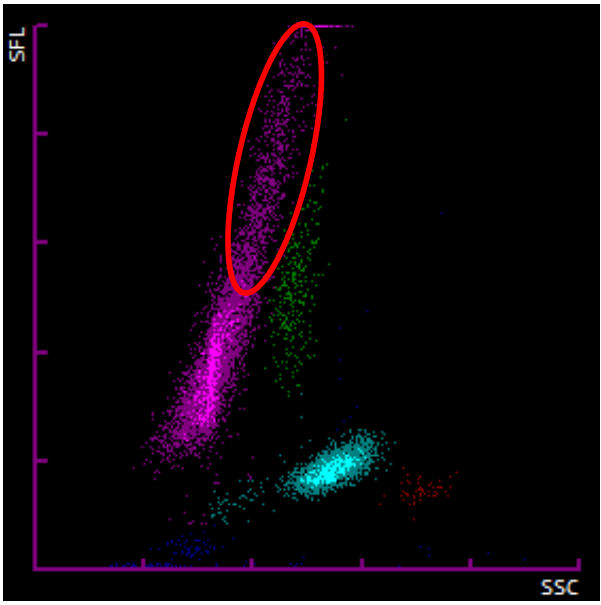 建议收藏血常规异常白细胞散点图案例汇总