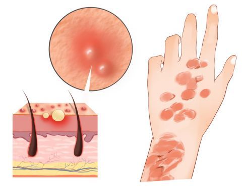 被诊断为"特应性皮炎",时而被诊断为"湿疹",也有中医认为是"四弯风"