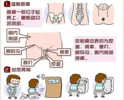 前列腺疼痛綜合徵